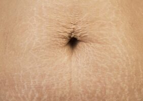 Μαύρη γραμμή στην κοιλιά: Τι είναι πραγματικά και γιατί εμφανίζεται