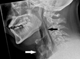 Τραυματισμός-σοκ: Άνδρας «έπνιξε» έναν φτέρνισμα και τρύπησε την τραχεία του