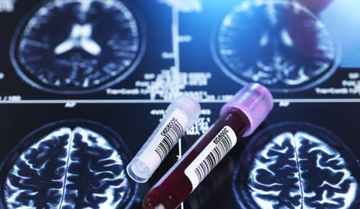 Alzheimer, Αλτσχάιμερ